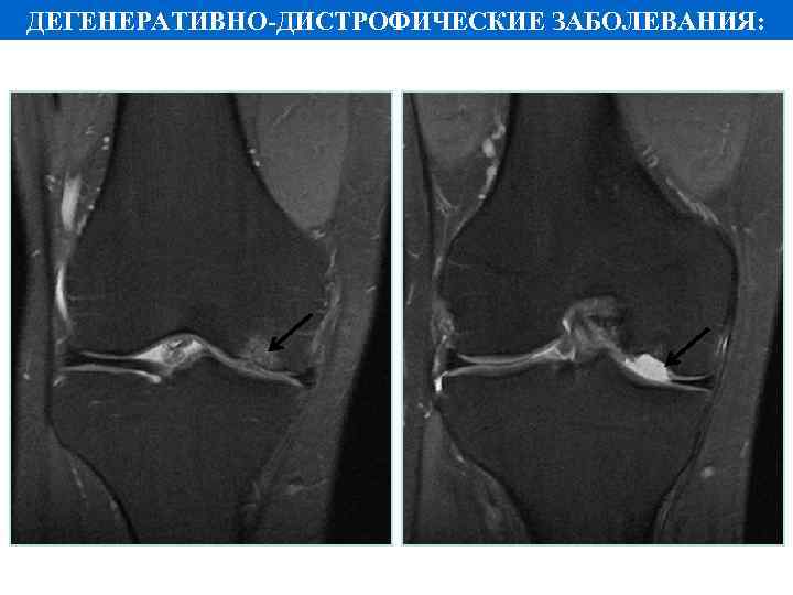 ДЕГЕНЕРАТИВНО-ДИСТРОФИЧЕСКИЕ ЗАБОЛЕВАНИЯ: 