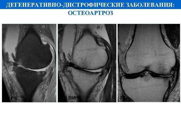ДЕГЕНЕРАТИВНО-ДИСТРОФИЧЕСКИЕ ЗАБОЛЕВАНИЯ: ОСТЕОАРТРОЗ PD FS Т 2 ВИ PD 