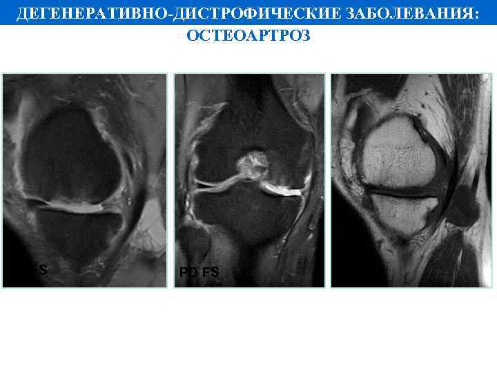 ДЕГЕНЕРАТИВНО-ДИСТРОФИЧЕСКИЕ ЗАБОЛЕВАНИЯ: ОСТЕОАРТРОЗ PD FS Т 1 ВИ 