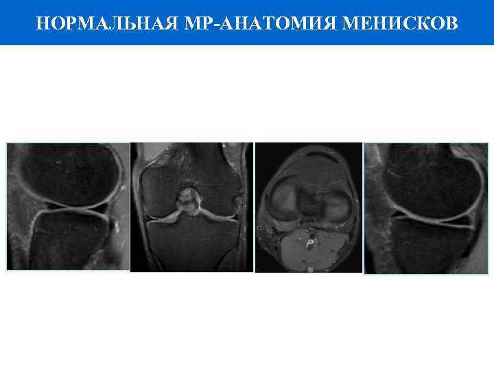 НОРМАЛЬНАЯ МР-АНАТОМИЯ МЕНИСКОВ - В то время как медиальный мениск имеет выступающий задний рог,