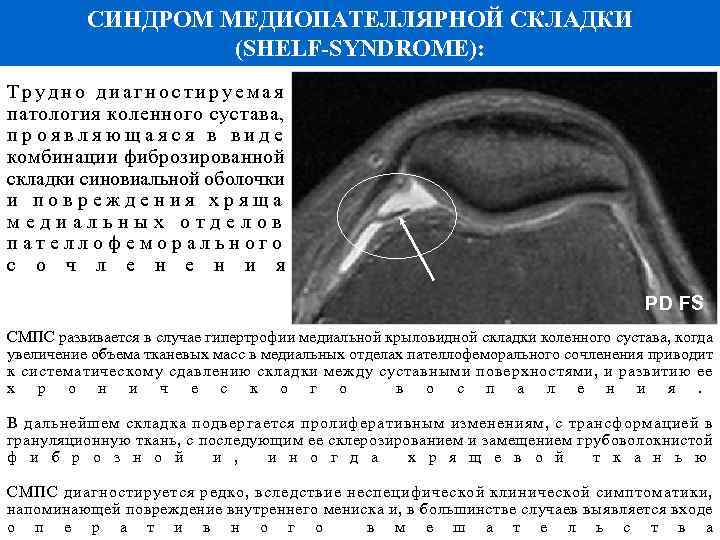 Синдромом операция. Синдром патологической медиопателлярной складки коленного сустава. Синдром синовиальной складки коленного сустава симптомы. Гипертрофия медиопателлярной складки коленного сустава симптомы. Медиопателлярная складка анатомия.