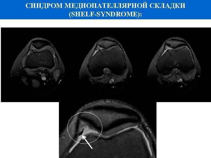 СИНДРОМ МЕДИОПАТЕЛЛЯРНОЙ СКЛАДКИ (SHELF-SYNDROME): PD FS 