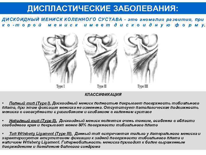 ДИСПЛАСТИЧЕСКИЕ ЗАБОЛЕВАНИЯ: ДИСКОИДНЫЙ МЕНИСК КОЛЕННОГО СУСТАВА это аномалия развития, при к о т о