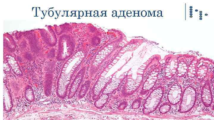 Тубулярная аденома 