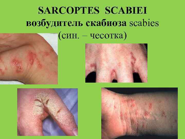 SARCOPTES SCABIEI возбудитель скабиоза scabies (син. – чесотка) 