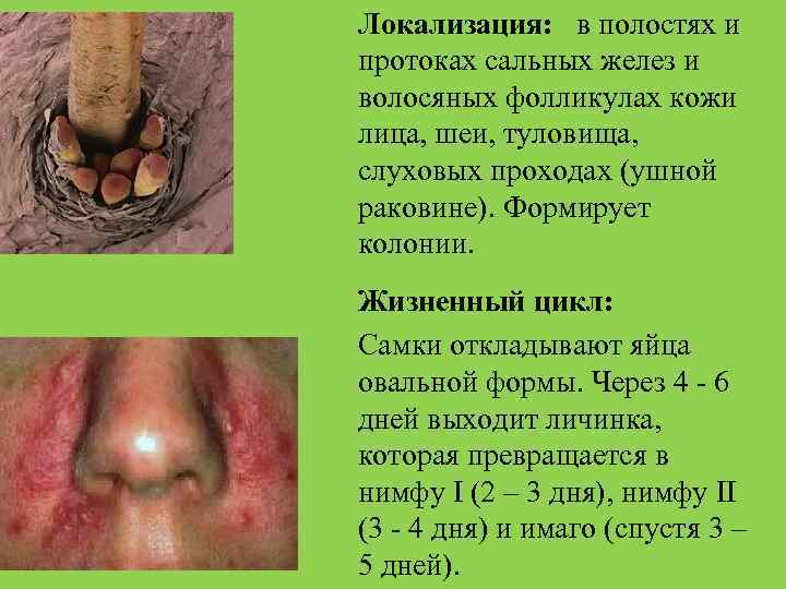 Локализация: в полостях и протоках сальных желез и волосяных фолликулах кожи лица, шеи, туловища,