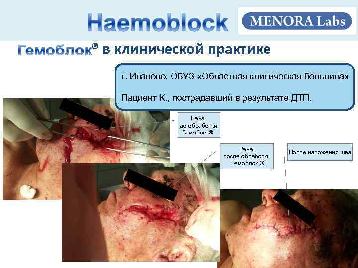 ® в клинической практике г. Иваново, ОБУЗ «Областная клиническая больница» Пациент К. , пострадавший