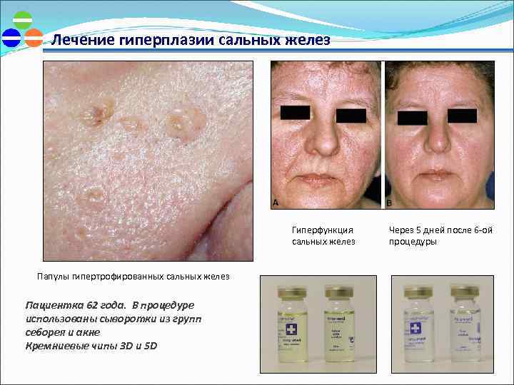 Лечение гиперплазии сальных желез Гиперфункция сальных желез Папулы гипертрофированных сальных желез Пациентка 62 года.