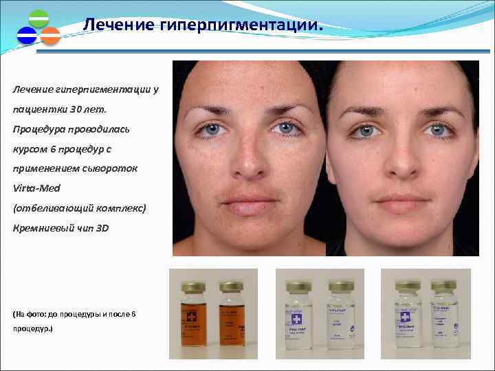 Лечение гиперпигментации. Лечение гиперпигментации у пациентки 30 лет. Процедура проводилась курсом 6 процедур с
