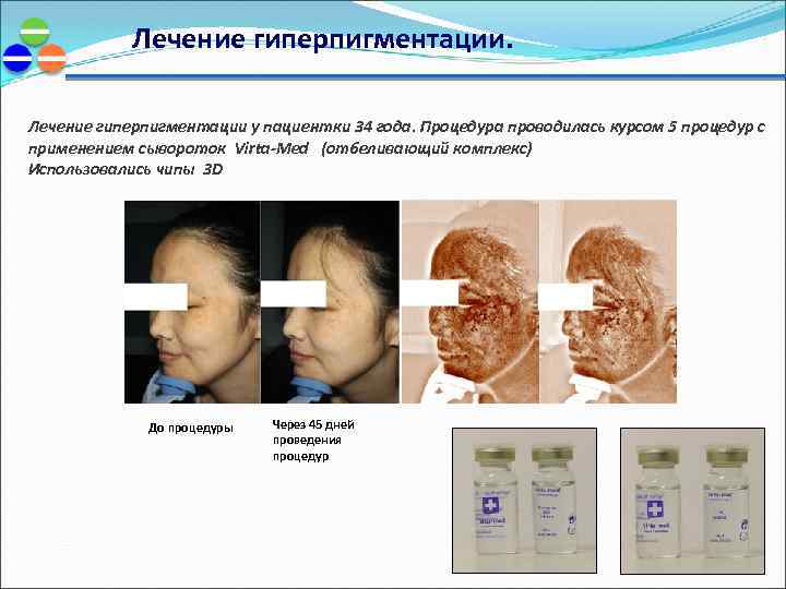 Лечение гиперпигментации. Лечение гиперпигментации у пациентки 34 года. Процедура проводилась курсом 5 процедур с