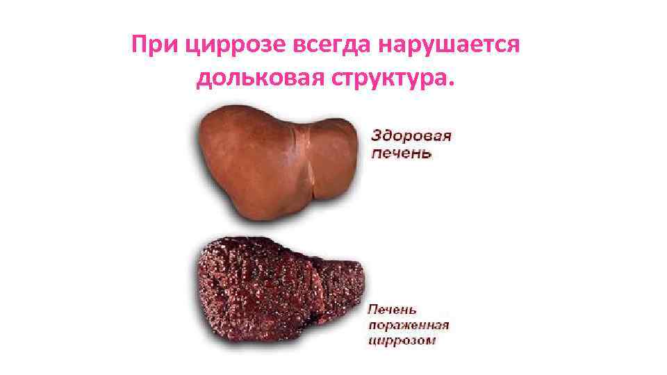 При циррозе всегда нарушается дольковая структура. 