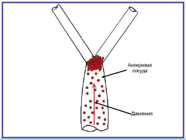 Аневризма сосуда Давление 