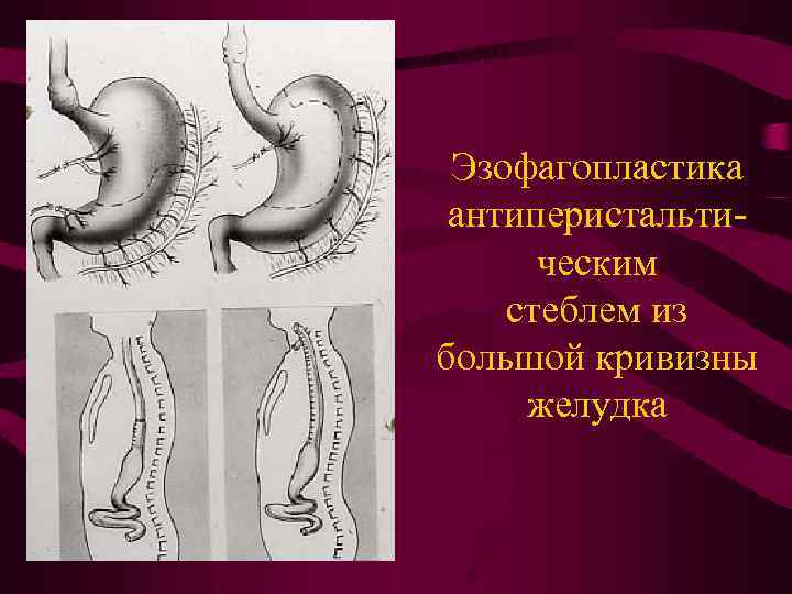 Эзофагопластика антиперистальтическим стеблем из большой кривизны желудка 