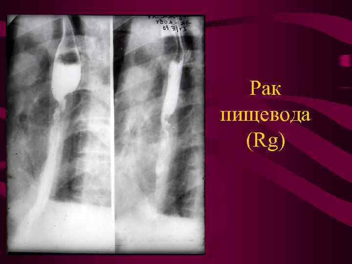 Рентгенологическая картина рака пищевода экзофитный эндофитный