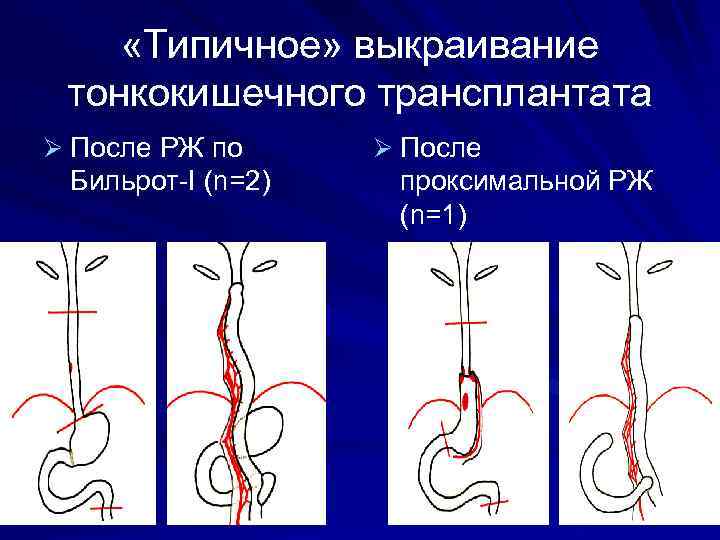  «Типичное» выкраивание тонкокишечного трансплантата Ø После РЖ по Бильрот-I (n=2) Ø После проксимальной