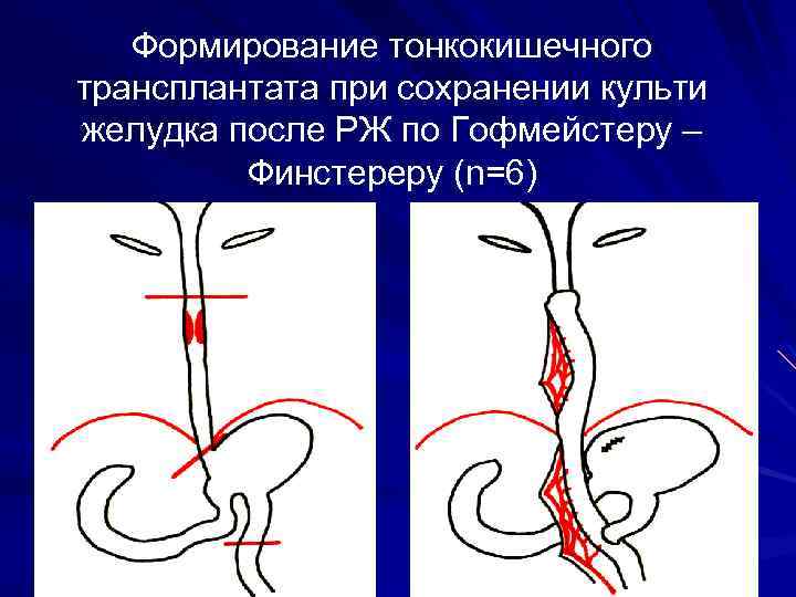 Формирование тонкокишечного трансплантата при сохранении культи желудка после РЖ по Гофмейстеру – Финстереру (n=6)