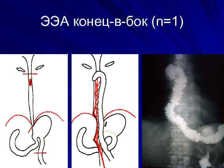 ЭЭА конец-в-бок (n=1) 