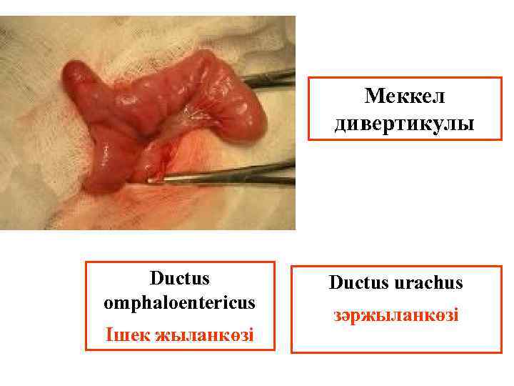Меккел дивертикулы Ductus оmphaloentericus Ішек жыланкөзі Ductus urachus зәржыланкөзі 