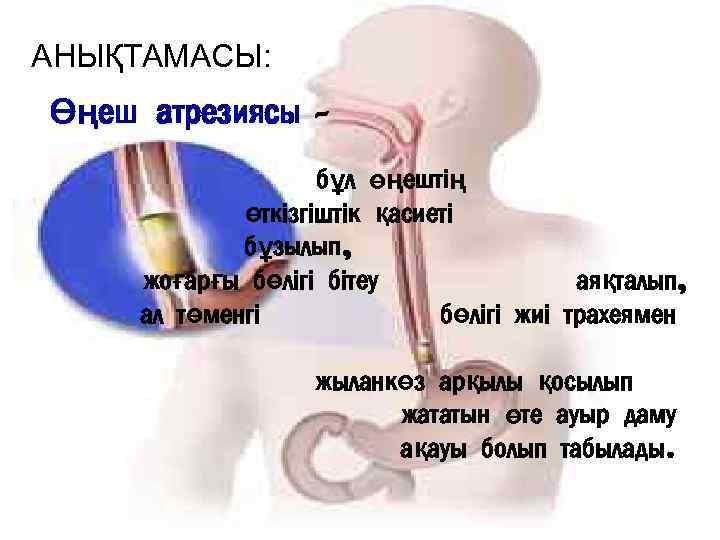 АНЫҚТАМАСЫ: Өңеш атрезиясы – бұл өңештің өткізгіштік қасиеті бұзылып, жоғарғы бөлігі бітеу аяқталып, ал