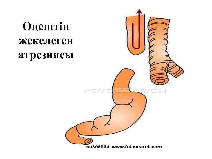 Өңештің жекелеген атрезиясы 