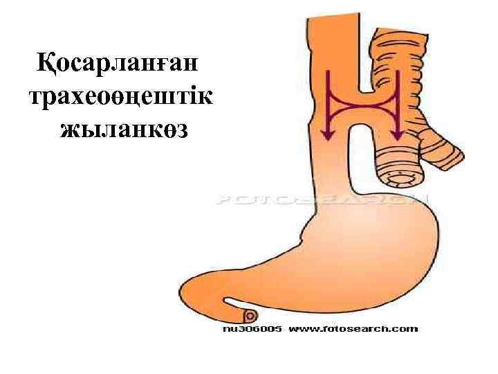 Қосарланған трахеоөңештік жыланкөз 