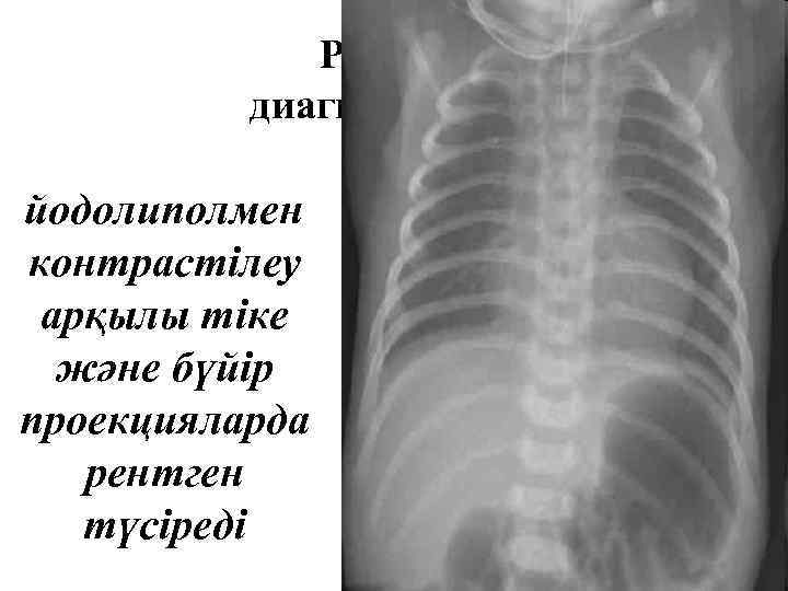 Рентген диагностикасы йодолиполмен контрастілеу арқылы тіке және бүйір проекцияларда рентген түсіреді 