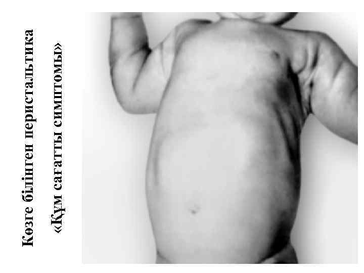  «Құм сағатты симптомы» Көзге білінген перистальтика 