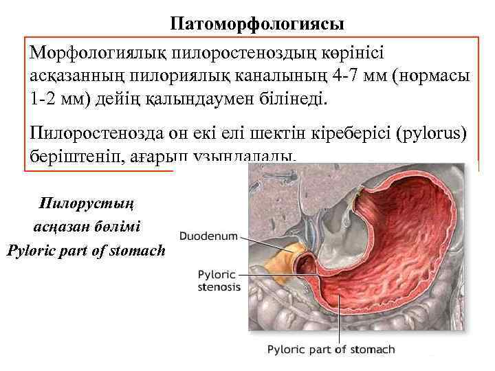 Патоморфологиясы Морфологиялық пилоростеноздың көрінісі асқазанның пилориялық каналының 4 -7 мм (нормасы 1 -2 мм)