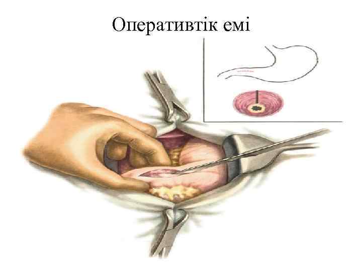 Оперативтік емі 