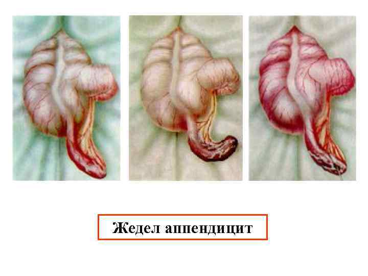 Жедел аппендицит 