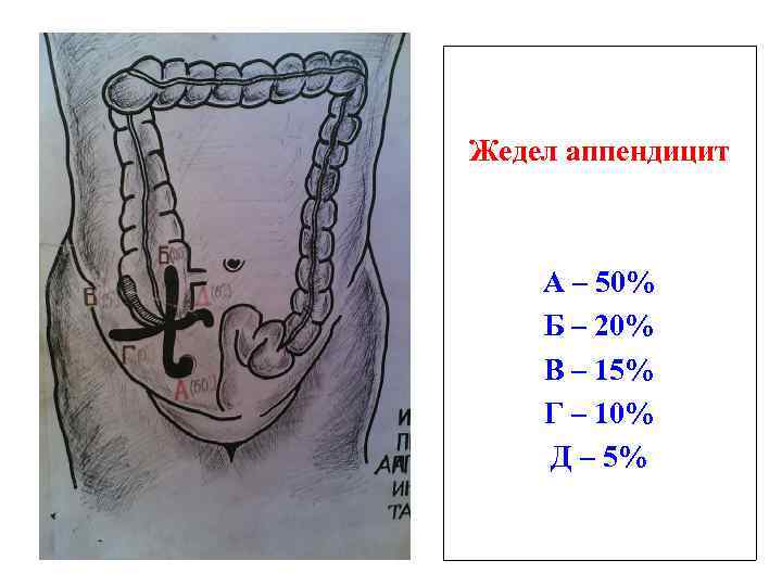 Жедел аппендицит А – 50% Б – 20% В – 15% Г – 10%
