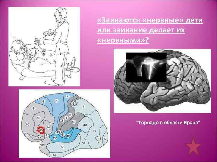  «Заикаются «нервные» дети или заикание делает их «нервными» ? "Торнадо в области Брока"
