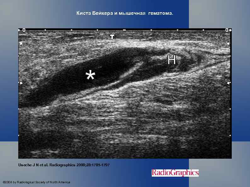 Узи мышц. УЗИ картина кист Бейкера. Разрыв кисты Бейкера на УЗИ. Внутримышечная гематома на УЗИ.