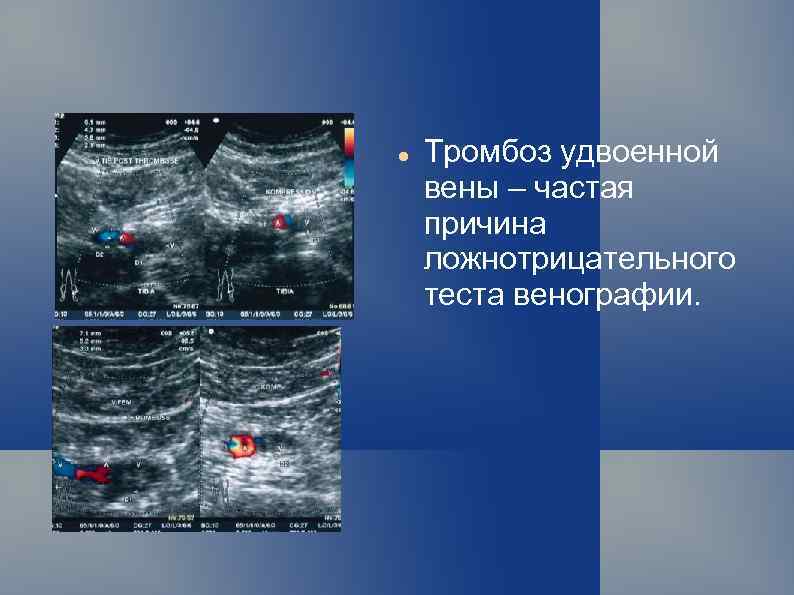 Острые тромбозы системы нижней полой вены презентация