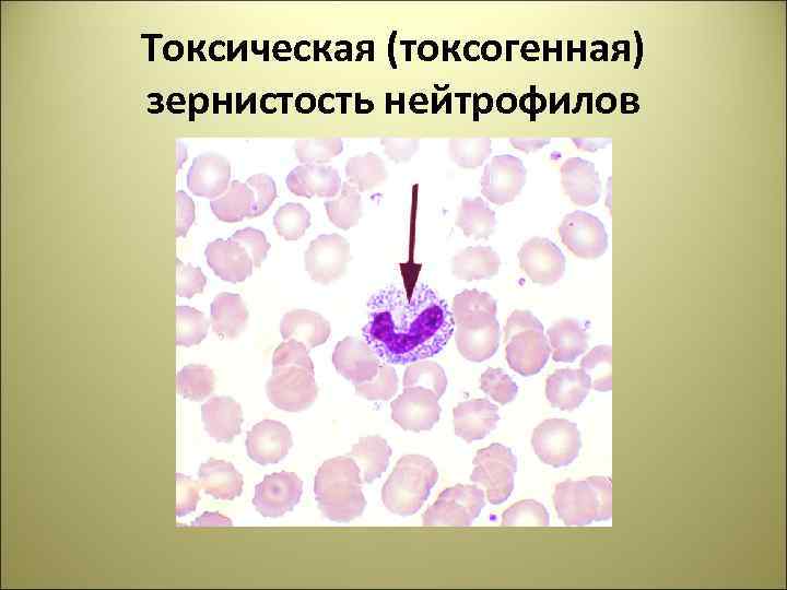 Токсогенная зернистость нейтрофилов. Токсикогенная зернистость нейтрофилов. Токсическая зернистость нейтрофилов вакуолизация. Токсическая (токсогенная) зернистость нейтрофилов. В мазке крови: токсигенная зернистость нейтрофилов.