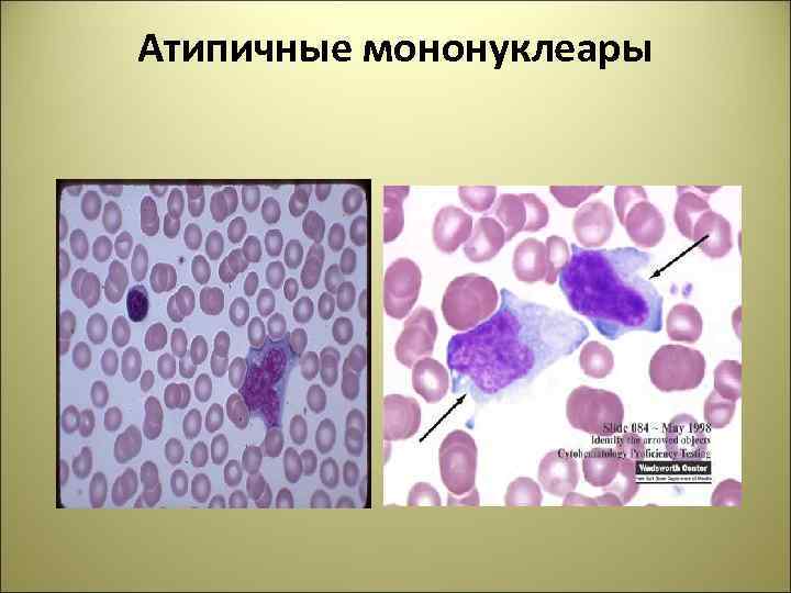 Атипичные мононуклеары картинки