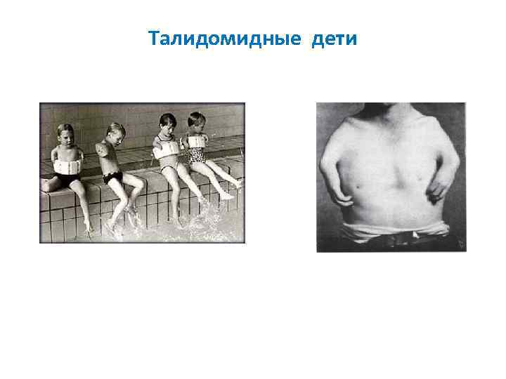 Талидомидные дети 