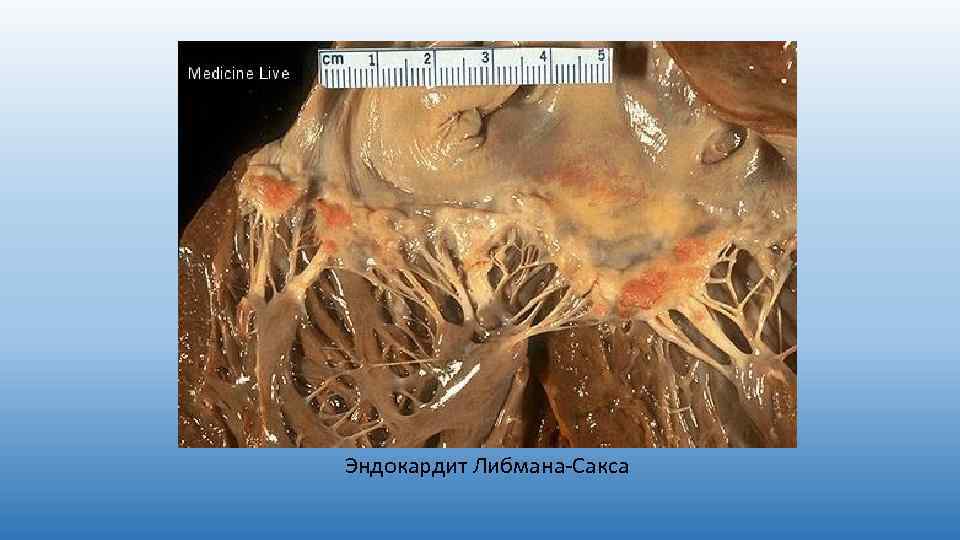 Эндокардит Либмана-Сакса 