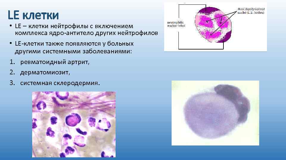 LE клетки • LE – клетки нейтрофилы с включением комплекса ядро-антитело других нейтрофилов •
