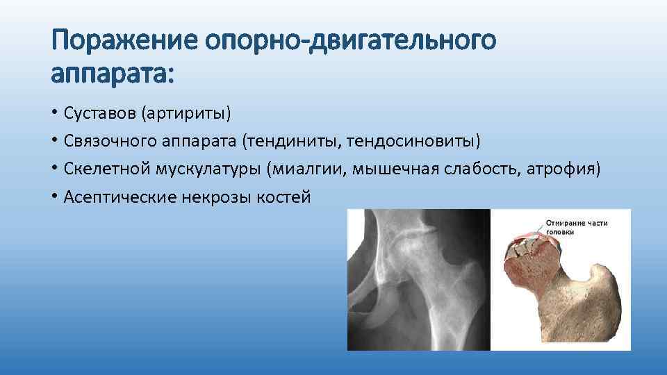 Поражение опорно-двигательного аппарата: • Суставов (артириты) • Связочного аппарата (тендиниты, тендосиновиты) • Скелетной мускулатуры