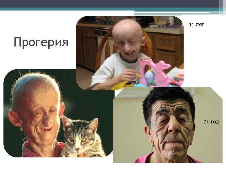 11 лет Прогерия 21 год 