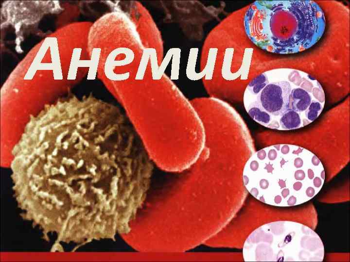 Анемии 