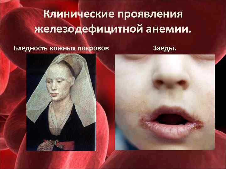 Клинические проявления железодефицитной анемии. Бледность кожных покровов Заеды. 