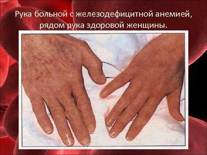 Рука больной с железодефицитной анемией, рядом рука здоровой женщины. 