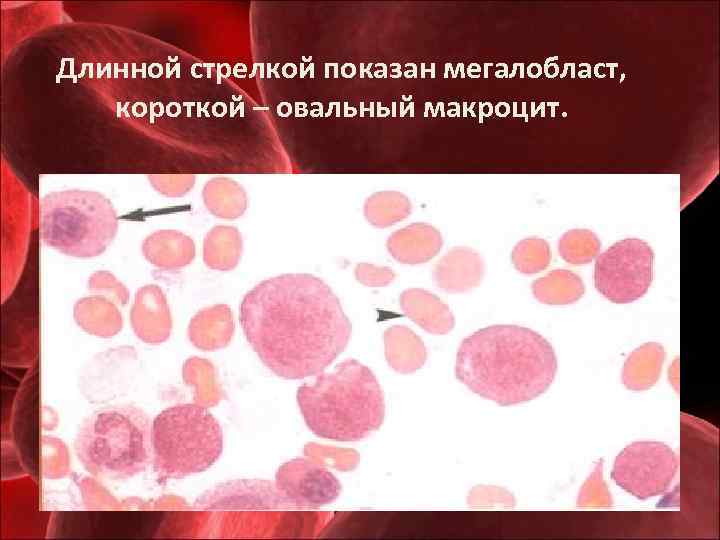 Длинной стрелкой показан мегалобласт, короткой – овальный макроцит. 