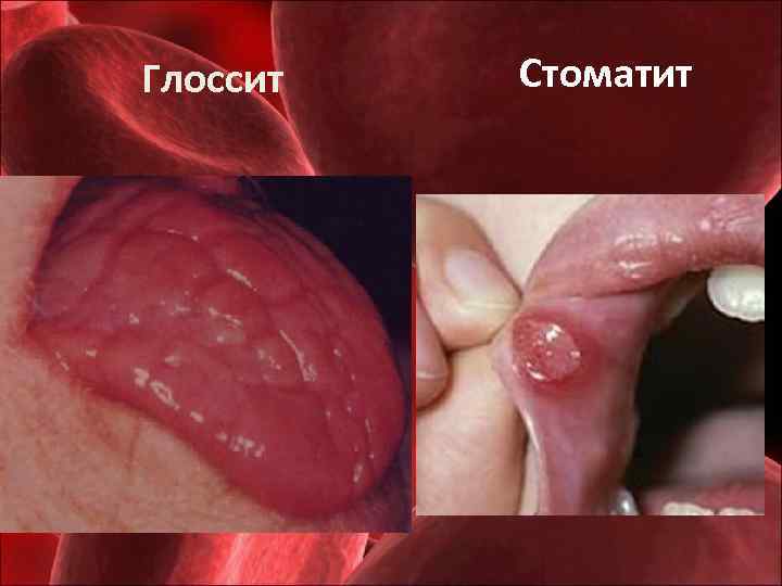 Глоссит Стоматит 