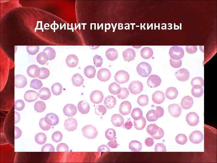 Дефицит пируват-киназы 