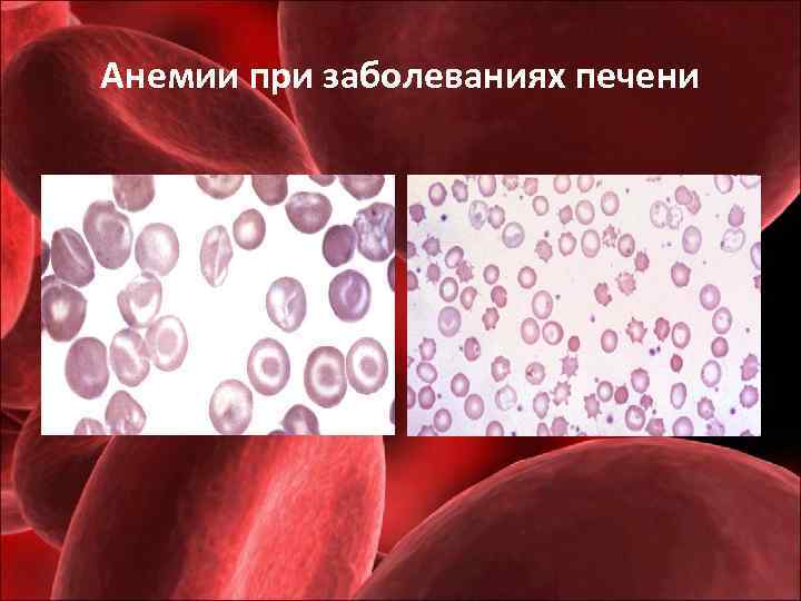 Анемии при заболеваниях печени 