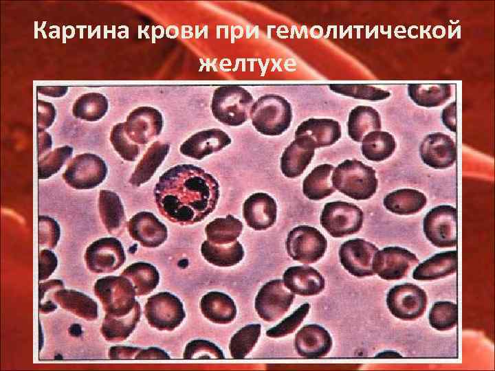 Картина крови при гемолитической желтухе 
