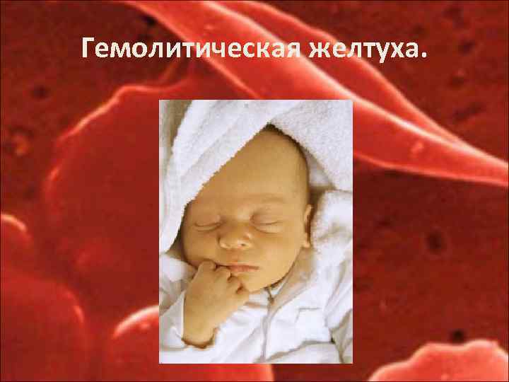 Гемолитическая желтуха. 